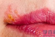 为什么每年嘴唇都长一次疱疹（为什么每年嘴唇都长一次疱疹呢）