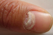 好多人灰指甲都不治正常吗