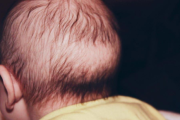 婴儿头发秃一圈是缺钙吗？枕秃了解一下！